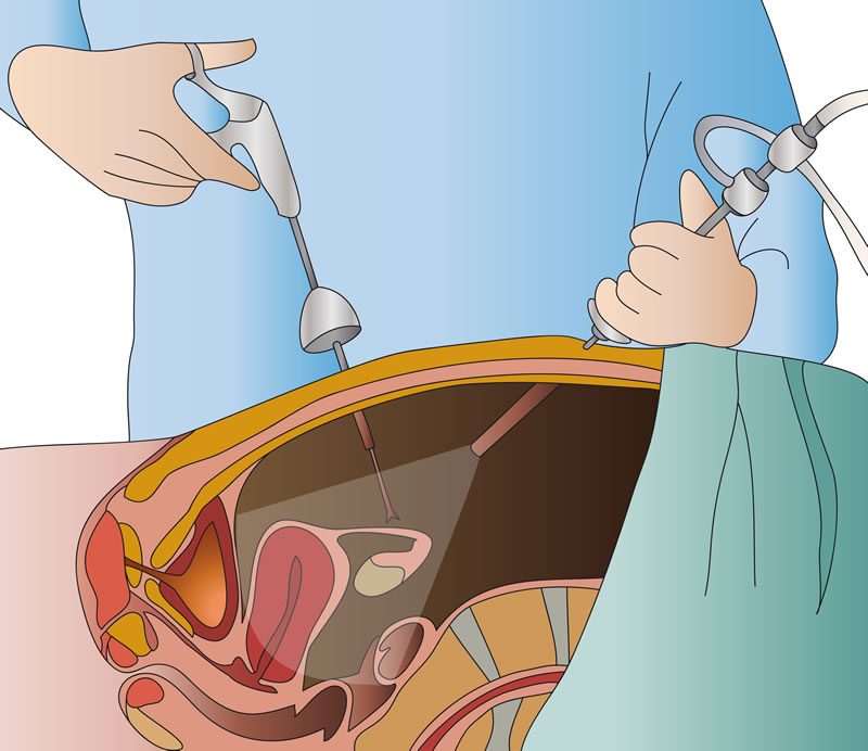 Ooforoplastia e Salpingectomia 